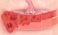 Врастание плаценты: эффективные методы остановки послеродового кровотечения