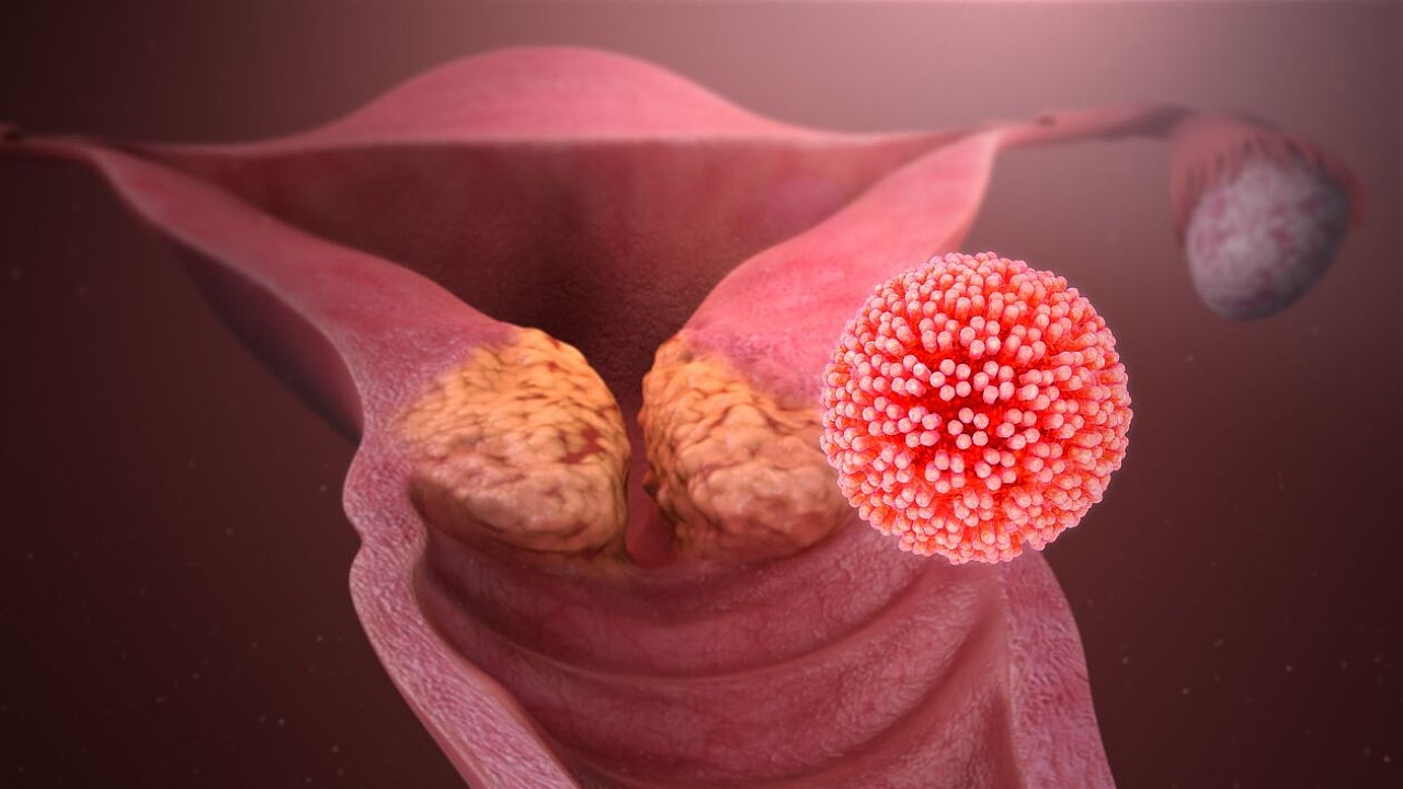 Взаимодействие вируса Эпштейна — Барр и вируса папилломы человека в канцерогенезе шейки матки