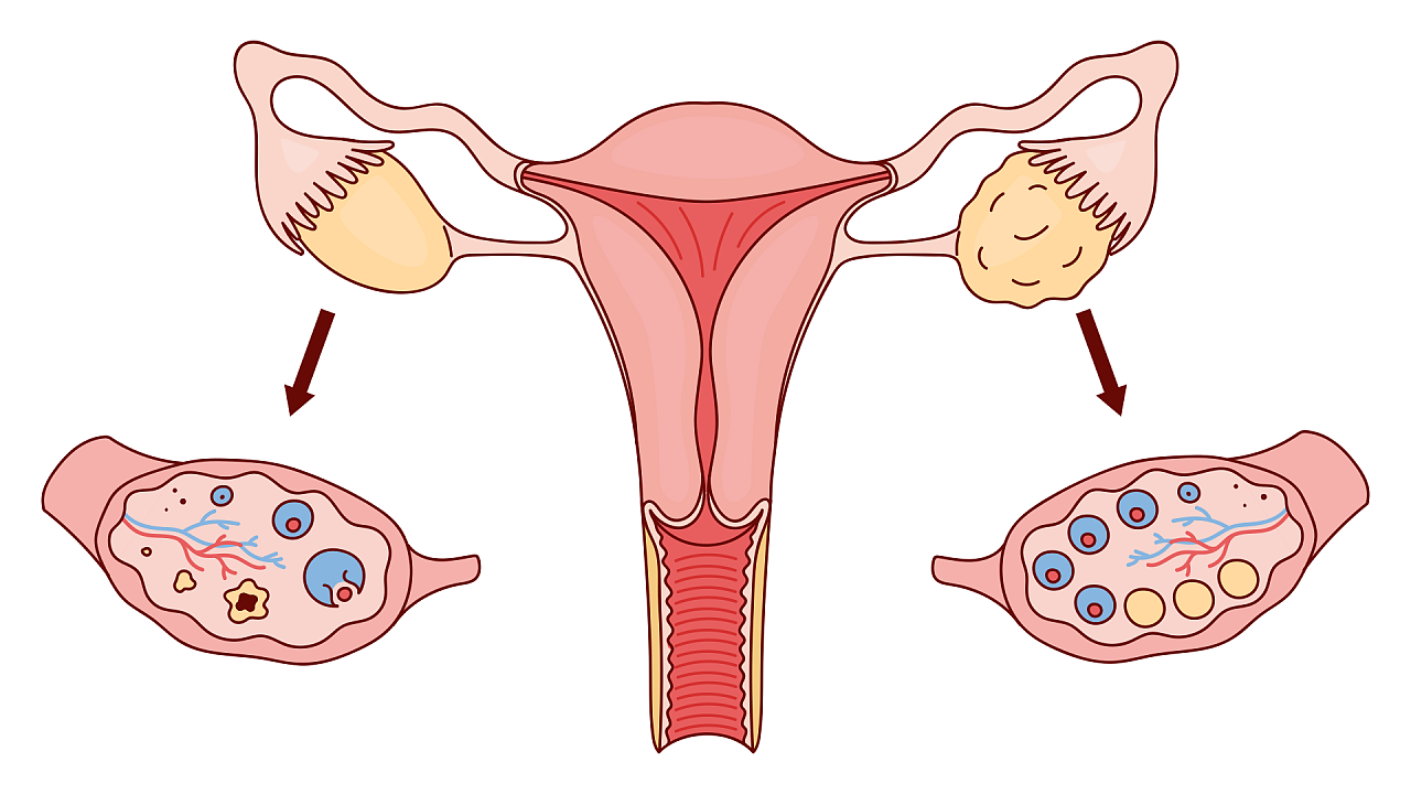Как синдром поликистозных яичников влияет на функционирование вегетативной нервной системы?